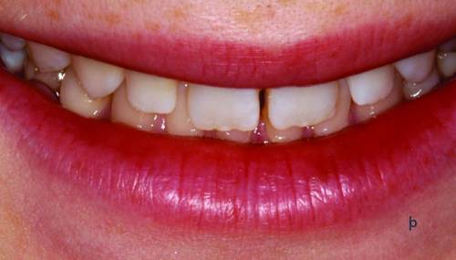 Teeth, smile, restoration