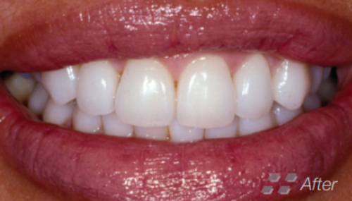 Teeth, smile restoration