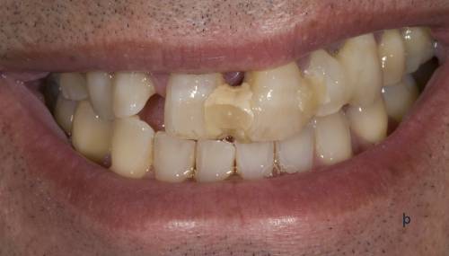 Teeth, yellowing teeth, teeth cleaning