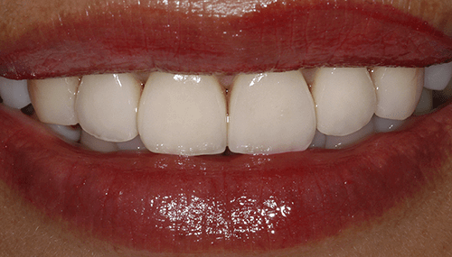 Teeth, smile, restoration